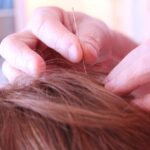Chinese Scalp Acupuncture
